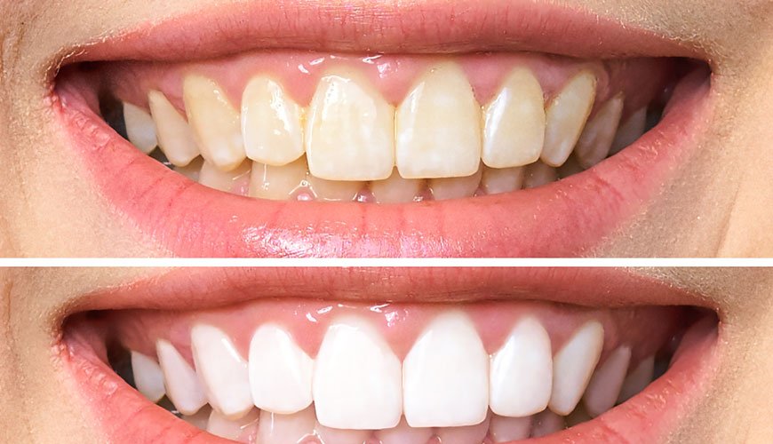 emax kaplama hangi dişlere uygulanır
