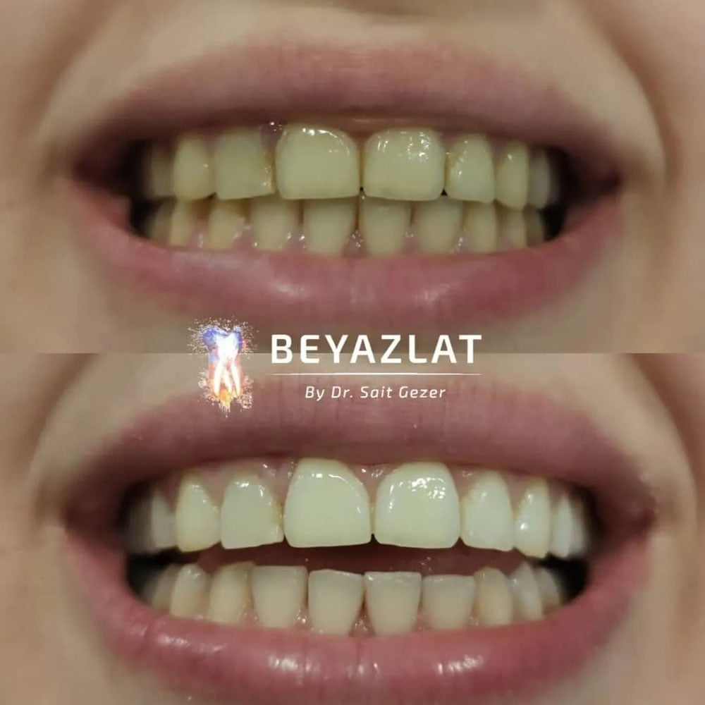 Diş Beyazlatma