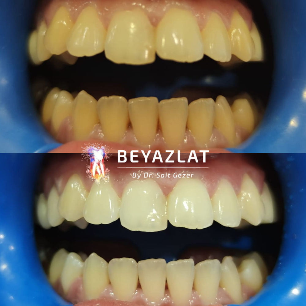 Diş Beyazlatma