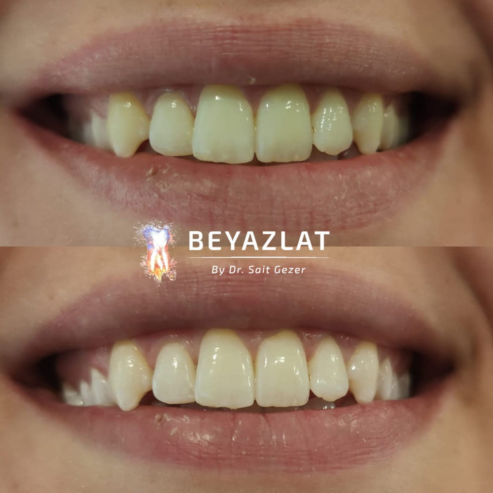 Diş Beyazlatma